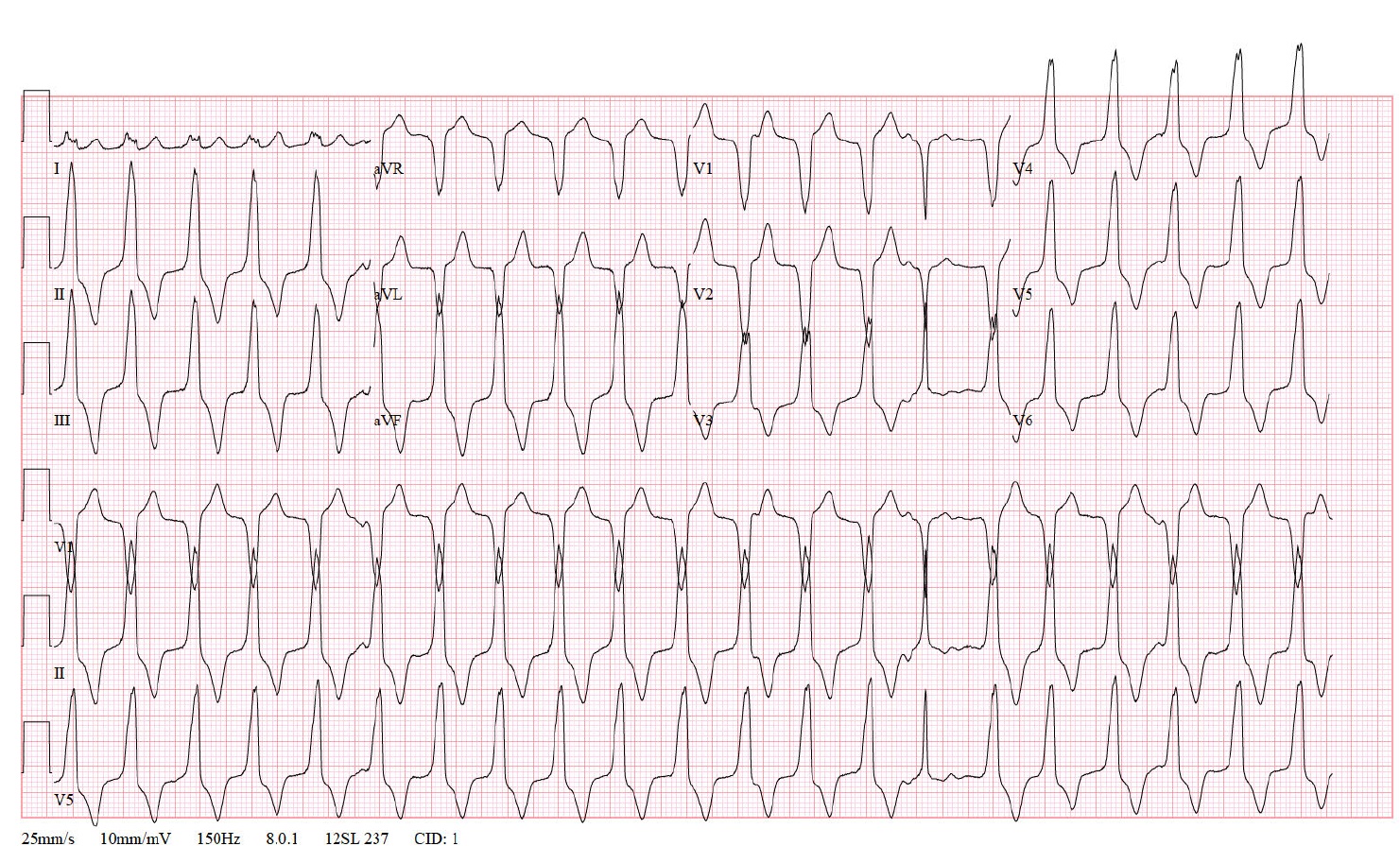 Image: Ventricular_Tachycardia.jpg