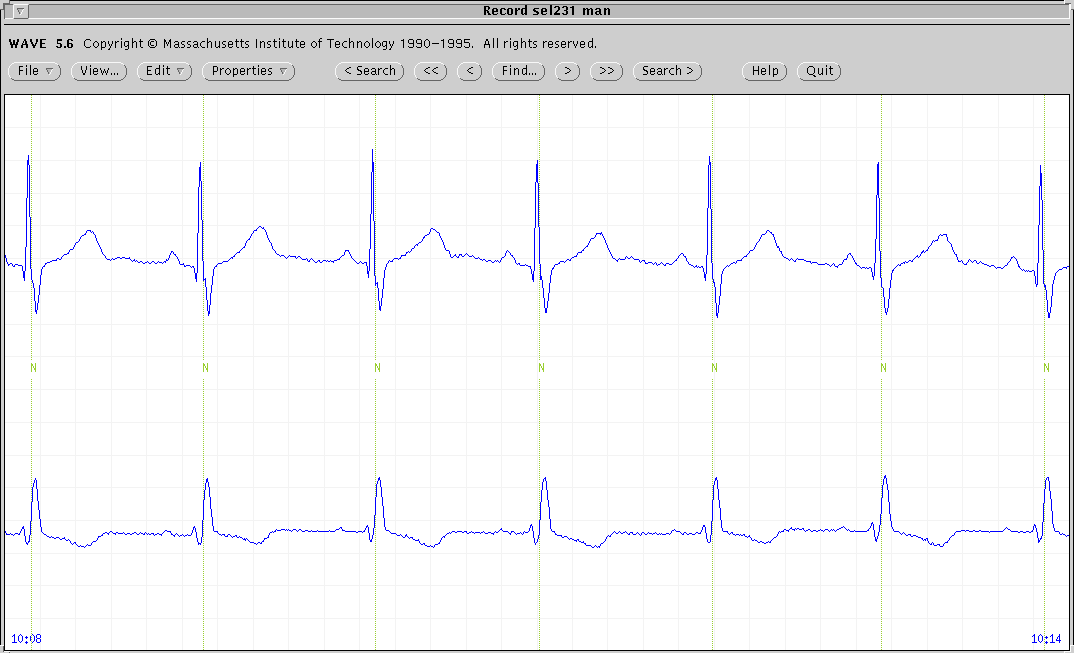 \begin{figure*}
{\centering\epsfig{file=ecg.eps,width=\linewidth}}
\vspace{-0.25cm}
\end{figure*}